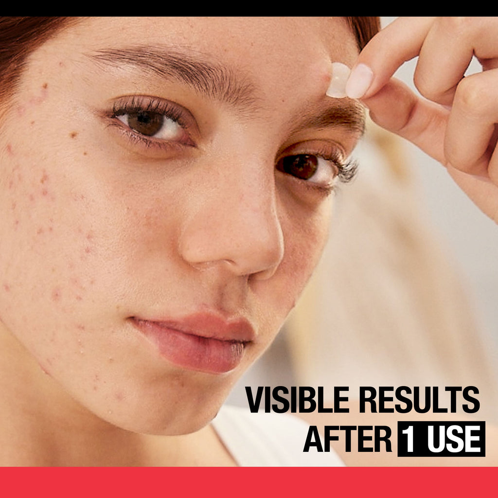 Acne Solutions: Cleanser, Treatment, & Patches, 3 Items